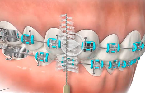 Braces video Southern Maine Orthodontics in Scarborough, ME