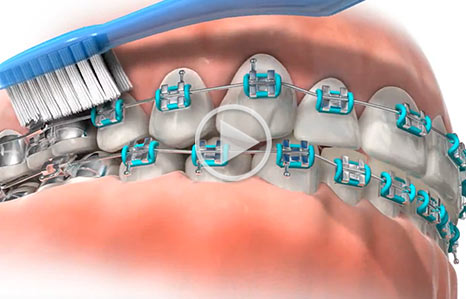 Brushing video Southern Maine Orthodontics in Scarborough, ME