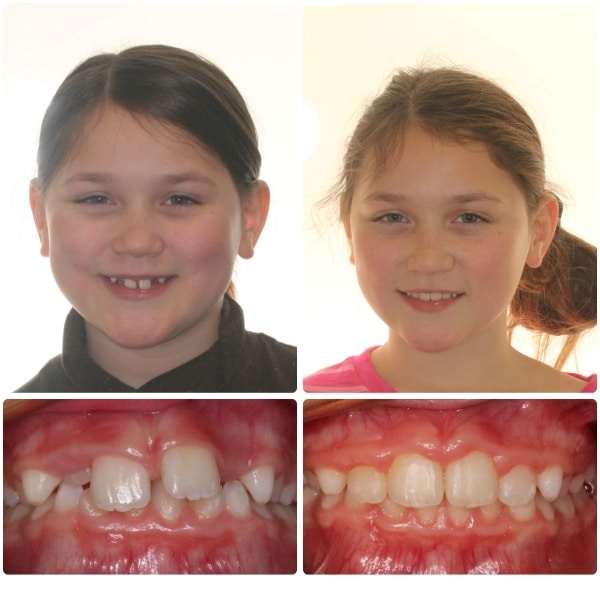 Before and After Orthodontic Results | Southern Maine Orthodontics