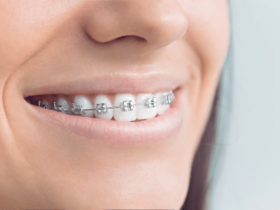How Metal Braces Feel in the First Few Day Southern Maine Orthodontics in Scarborough and Gorham, ME