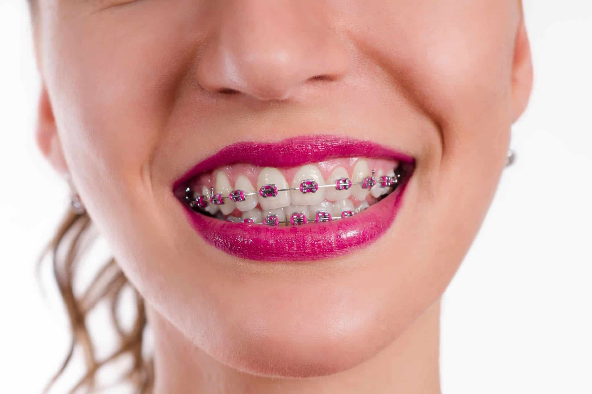 Orthodontic Treatment Timeline: Helpful Guide Southern Maine Orthodontics in Scarborough or Gorham, ME